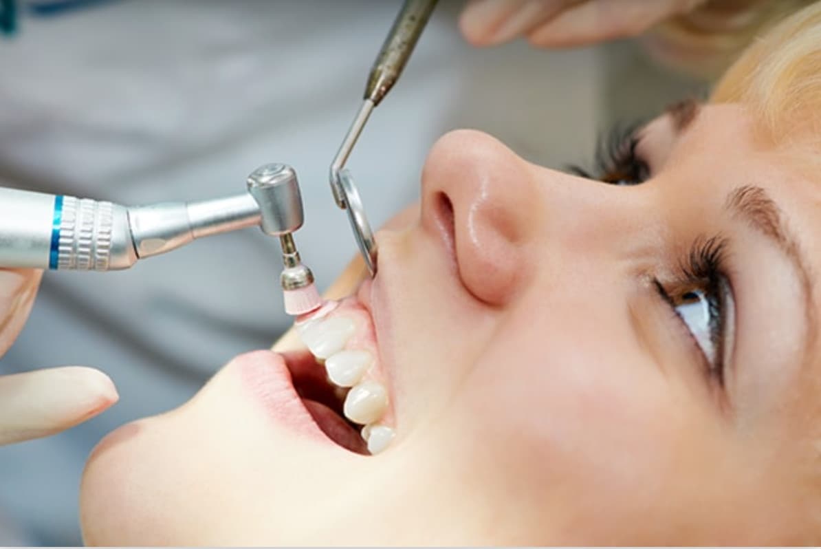 Profilaxis dental con ultrasonido